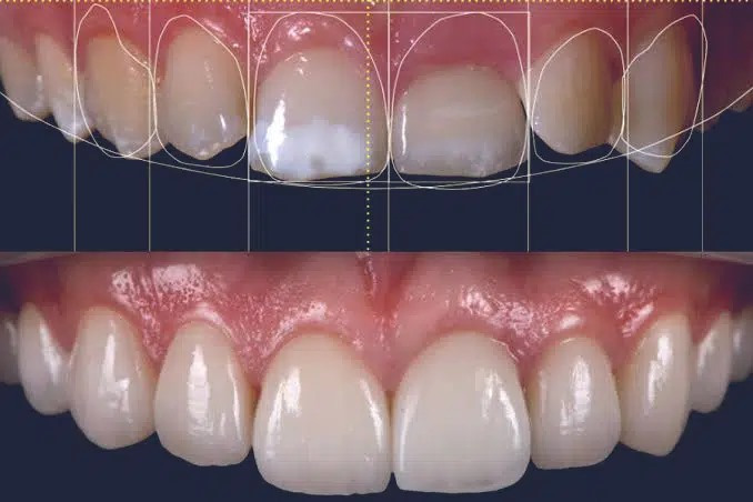 smile design